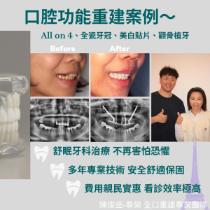 All on 4全口重建02