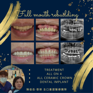 All on 4全口重建