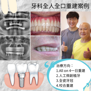 All on 4全口重建