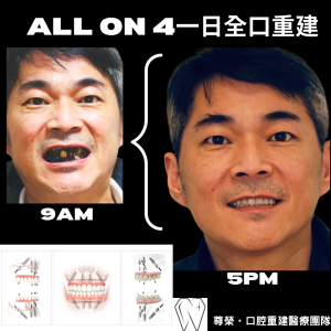 All on 4全口重建