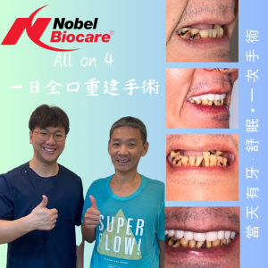 All on 4全口重建