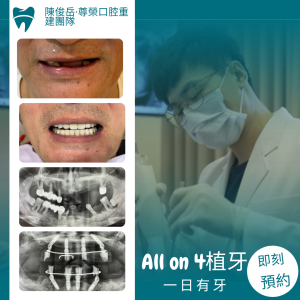 All on 4全口重建05