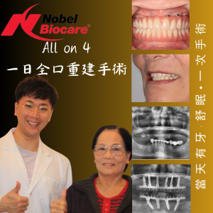 All on 4全口重建