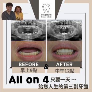 All on 4全口重建