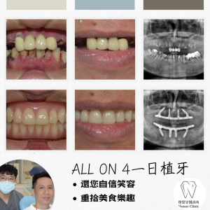 All on 4全口重建