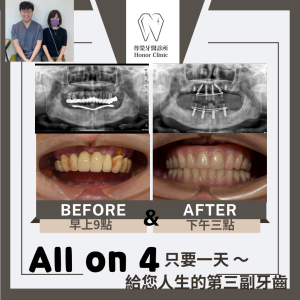 All on 4全口重建