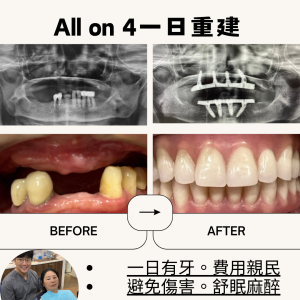 All on 4全口重建