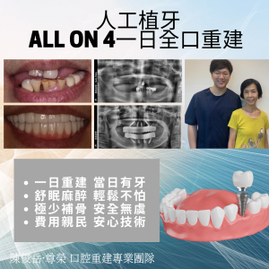 All on 4全口重建