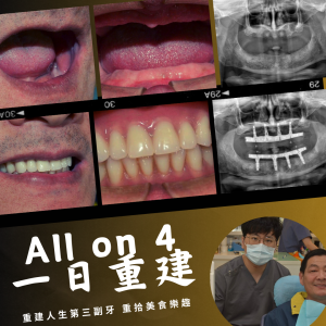 All on 4全口重建