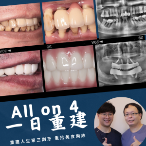 All on 4全口重建