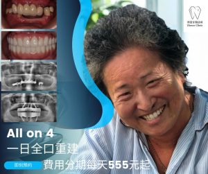 All on 4全口重建