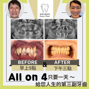 All on 4全口重建