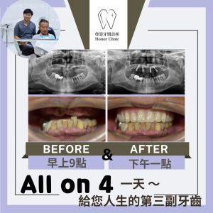 All on 4全口重建