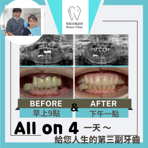 All on 4全口重建