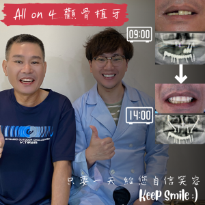 All on 4全口重建