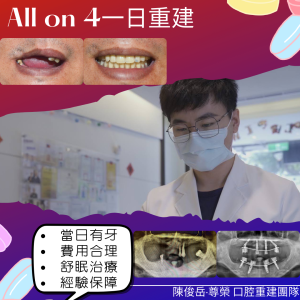 All on 4全口重建