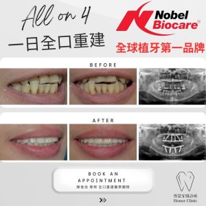 All on 4全口重建