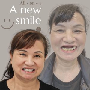 All on 4全口重建