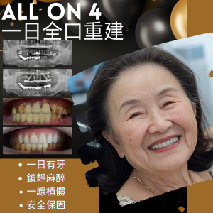 All on 4全口重建