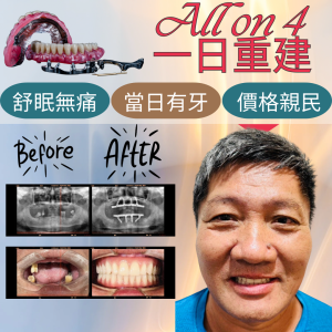 All on 4全口重建