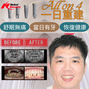 All on 4全口重建