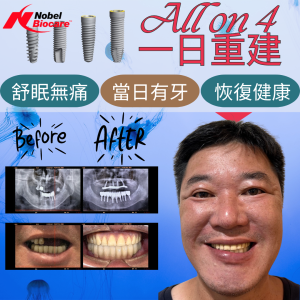 All on 4全口重建