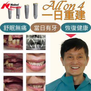 All on 4全口重建