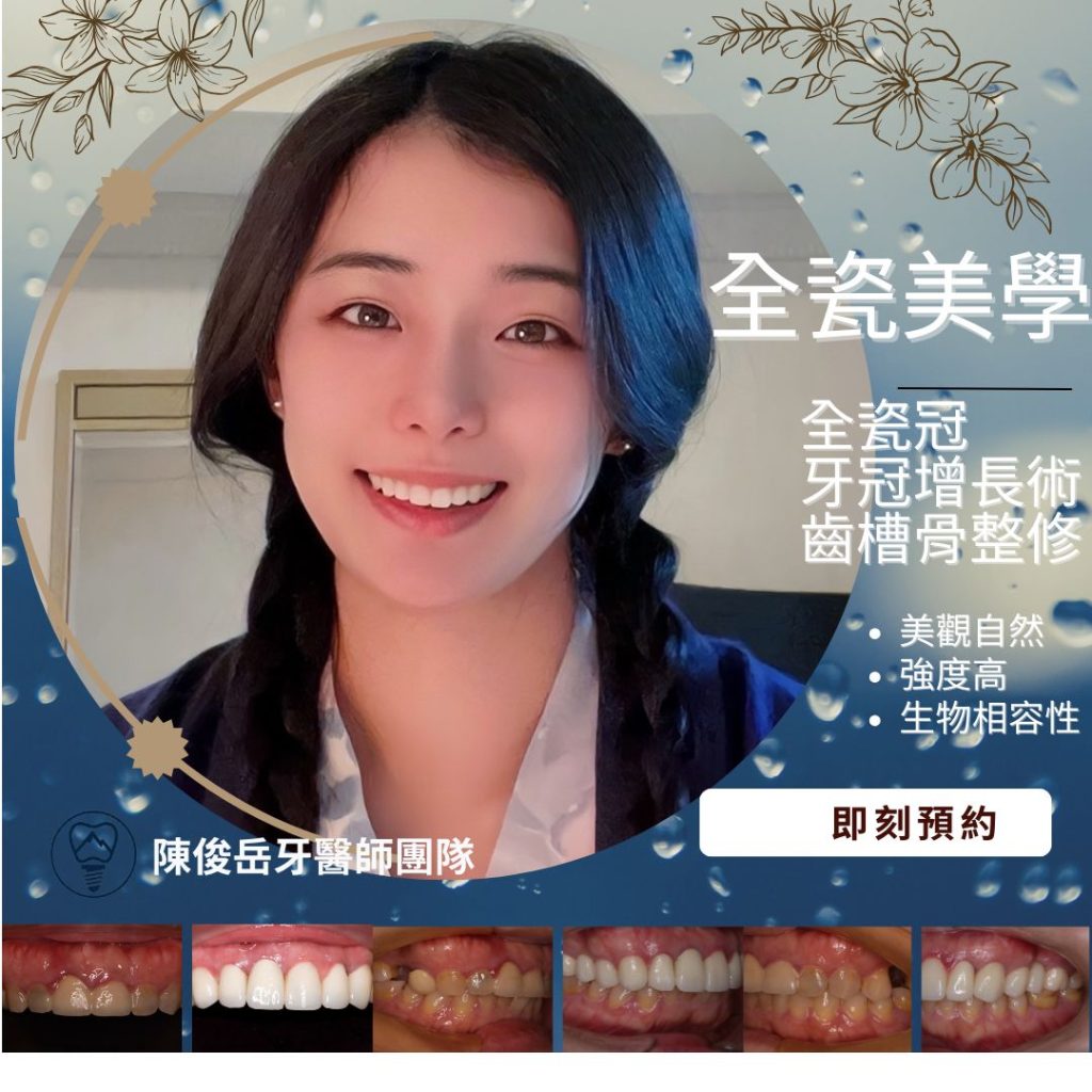 全瓷冠 vs 全瓷貼片怎麼選最耐用？牙醫師給你最誠實建議 - 台南 All-on-4 牙齒專家｜一日重建 全口新生｜ 陳俊岳植牙專業團隊