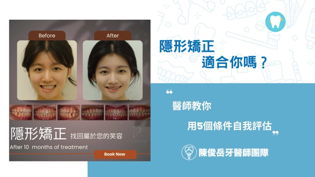 隱形矯正